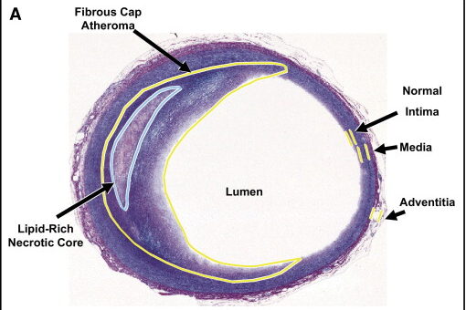 The coronary arteries of a young man who passed from an incidental cause is found to have atherosclerosis. 